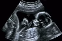 Siêu âm thấy con trai lè lưỡi dễ thương, ai ngờ bi kịch