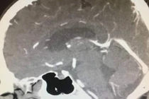 Khối u trong não kỳ dị, trước hôm phẫu thuật, biến mất bí ẩn...