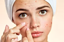 Lý do phái đẹp không nên nặn mụn