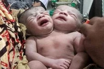 Bé gái hai đầu được hàng ngàn người tôn thờ như Thượng đế”