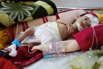 Nỗi đau của cặp vợ chồng hiếm muộn sinh con mắc bệnh Down