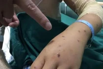 Người mẹ tự nguyện để ong đốt 200 nốt và lý do ấm lòng