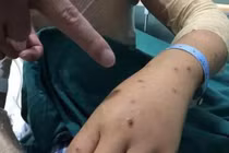 Người mẹ tự nguyện để ong đốt 200 nốt và lý do ấm lòng