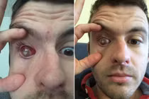 Khiếp sợ thanh niên mù cả mắt chỉ vì điều đơn giản này 