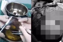 Chó hoang cắn khắp đầu mặt bé trai, 10 vết rướm máu kinh dị...