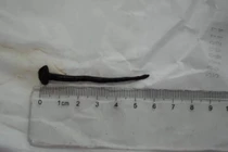 Cô gái ho ra máu 10 ngày, bác sĩ sốc khi tìm thấy vật kinh dị...