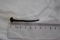 Cô gái ho ra máu 10 ngày, bác sĩ sốc khi tìm thấy vật kinh dị...