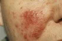 6 biểu hiện bất thường trên da cảnh báo bệnh nguy hiểm