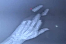 Thả diều ngày gió lớn, người đàn ông gặp chuyện khó tin