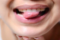 Tưởng bị nhiệt miệng giật mình phát hiện bị ung thư lưỡi