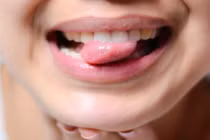 Tưởng bị nhiệt miệng giật mình phát hiện bị ung thư lưỡi