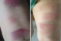 Bộ GD&ĐT nói gì vụ cô giáo bị tố đánh bầm tím chân 22 học sinh?