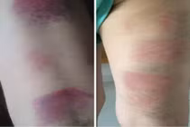 Bộ GD&ĐT nói gì vụ cô giáo bị tố đánh bầm tím chân 22 học sinh?