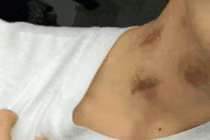 Cắn yêu, cô gái hại chết bạn trai vì lý do ai cũng dễ mắc