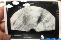 Con trai đột nhiên thích hôn bụng mẹ, người mẹ đi khám ngỡ ngàng...