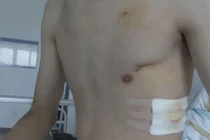 Thấy ngứa ngực, trai trẻ không ngờ mình suýt chết vì điều đáng sợ