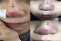 Trải nghiệm khủng khiếp sau khi nâng mũi bằng chỉ của thiếu nữ