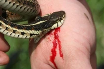 Chàng trai cắt chân khi bỏ bệnh viện về thầy lang chữa rắn cắn