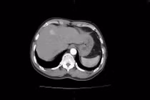 Bất ngờ phát hiện u gan sau khi đi khám sức khỏe