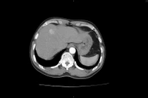 Bất ngờ phát hiện u gan sau khi đi khám sức khỏe