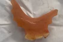 Vô tình nuốt răng giả khi ăn, dị vật thực quản nguy hiểm sao?