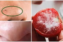 Tuyệt chiêu lột sạch mụn đầu đen chỉ bằng 1 quả cà chua