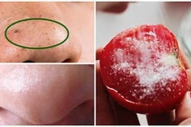 Tuyệt chiêu lột sạch mụn đầu đen chỉ bằng 1 quả cà chua