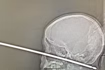 Thanh sắt xuyên thủng sọ, bé trai 10 tuổi sống sót kỳ diệu