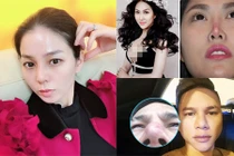 Đâu chỉ Lệ Quyên, nhiều sao Việt gặp họa vì nâng mũi