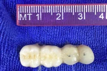 Cụ ông 90 tuổi suýt chết do... răng giả