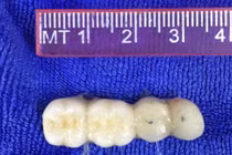 Cụ ông 90 tuổi suýt chết do... răng giả