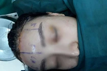 Rùng mình dịch vụ... cắt bỏ da đầu để sửa trán bớt cao