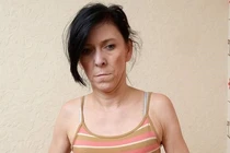 5 người mắc bệnh hiếm gặp nhất thế giới