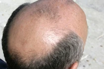 Đàn ông hói sớm ít bị ung thư tuyến tiền liệt