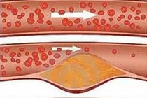 Rối loạn lipit máu có liên quan tới đột quỵ?