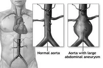 Kiểm soát cân nặng để tránh phình động mạch chủ