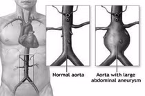 Kiểm soát cân nặng để tránh phình động mạch chủ