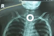 Sụt ký, nôn ói do nuốt dị vật