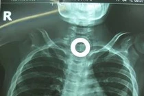 Sụt ký, nôn ói do nuốt dị vật