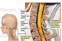 Cách điều trị bệnh gẫy cột sống cổ thấp có liệt tủy