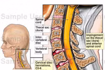 Cách điều trị bệnh gẫy cột sống cổ thấp có liệt tủy