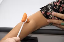 U xương ác tính thứ phát hay gặp ở tuổi nào?