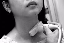 Người trẻ cũng bị ung thư tuyến giáp