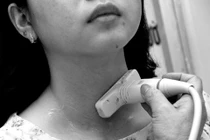 Người trẻ cũng bị ung thư tuyến giáp