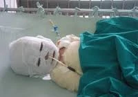 Bị bỏng vì mẹ bất cẩn khi đun bếp than