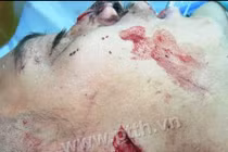 Nối tai cho thanh niên bị đồng nghiệp... xẻo