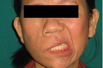 Giúp bệnh nhân liệt mặt có lại nụ cười