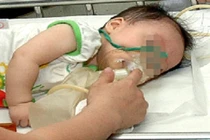 Hôn mê do cha mẹ tự cho dùng thuốc ho