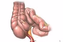 Vì sao viêm ruột thừa nhưng không mổ?