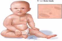 Có điều trị dứt điểm u xơ thần kinh?